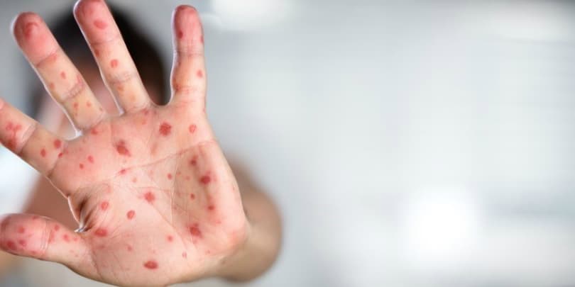 გასულ წელს მსოფლიოში წითელათი 140 ათასი ადამიანი გარდაიცვალა